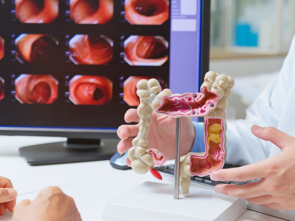 Foto del artículo: Detección precoz de cáncer de colon 